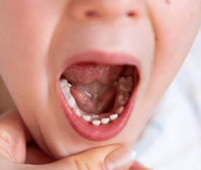 Young child opening mouth to show teeth